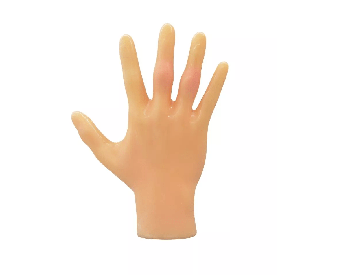 Rheumatisches Fingerphantom - Erler - Zimmer